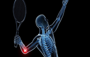 تنیس البو یا آرنج تنیس بازان چیست؟